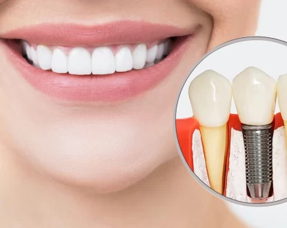Missing Teeth? Why Dental Implants Are the Best Solution